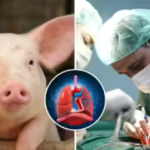 A Human Being Breathed with a Pig’s Lung for Nine Days in a first Xenotransplantation