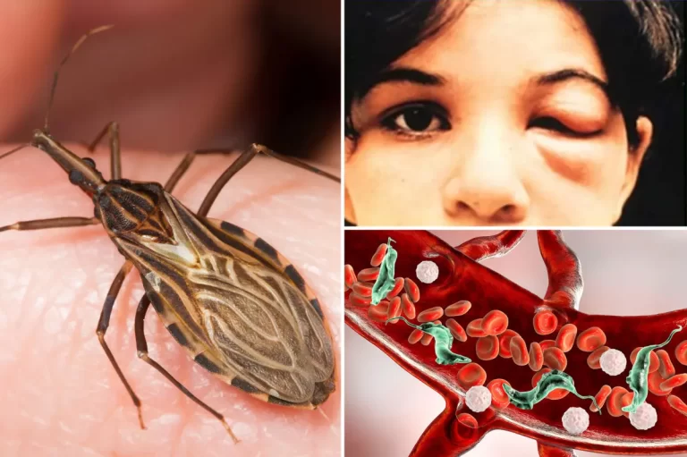 chagas-disease-kissing-bug