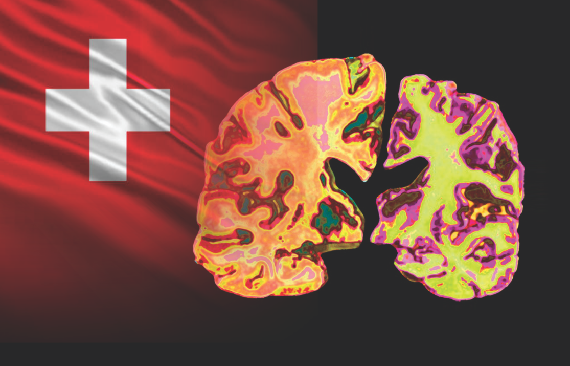Swiss Nanofilter Offers New Hope for Alzheimer’s; But Insurance Barriers Keep It Out of Reach