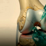 The Question of Cartilage Regrowth Breakthrough Raising Hope, Experts Urge Caution