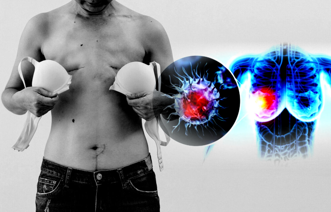 Cancer Catches a Killing-Cruise Daily with Over 26,000 Deaths, according to WHO